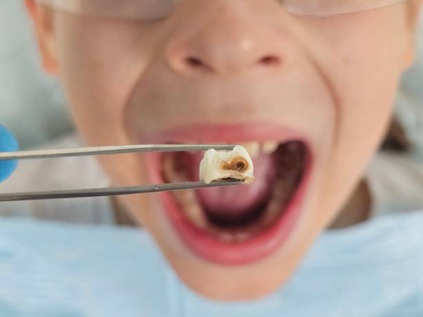 Best Emergency Tooth Extraction in Bayou Cane, LA